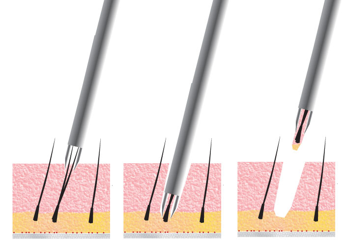 FUE - Follicular Unit Extraction