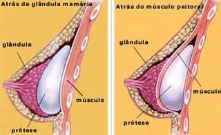 Prótese mamária