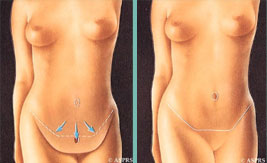 Abdominoplastia